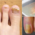 This 2-Ingredients Recipe Will Help You Get Rid Of Nail Fungus!